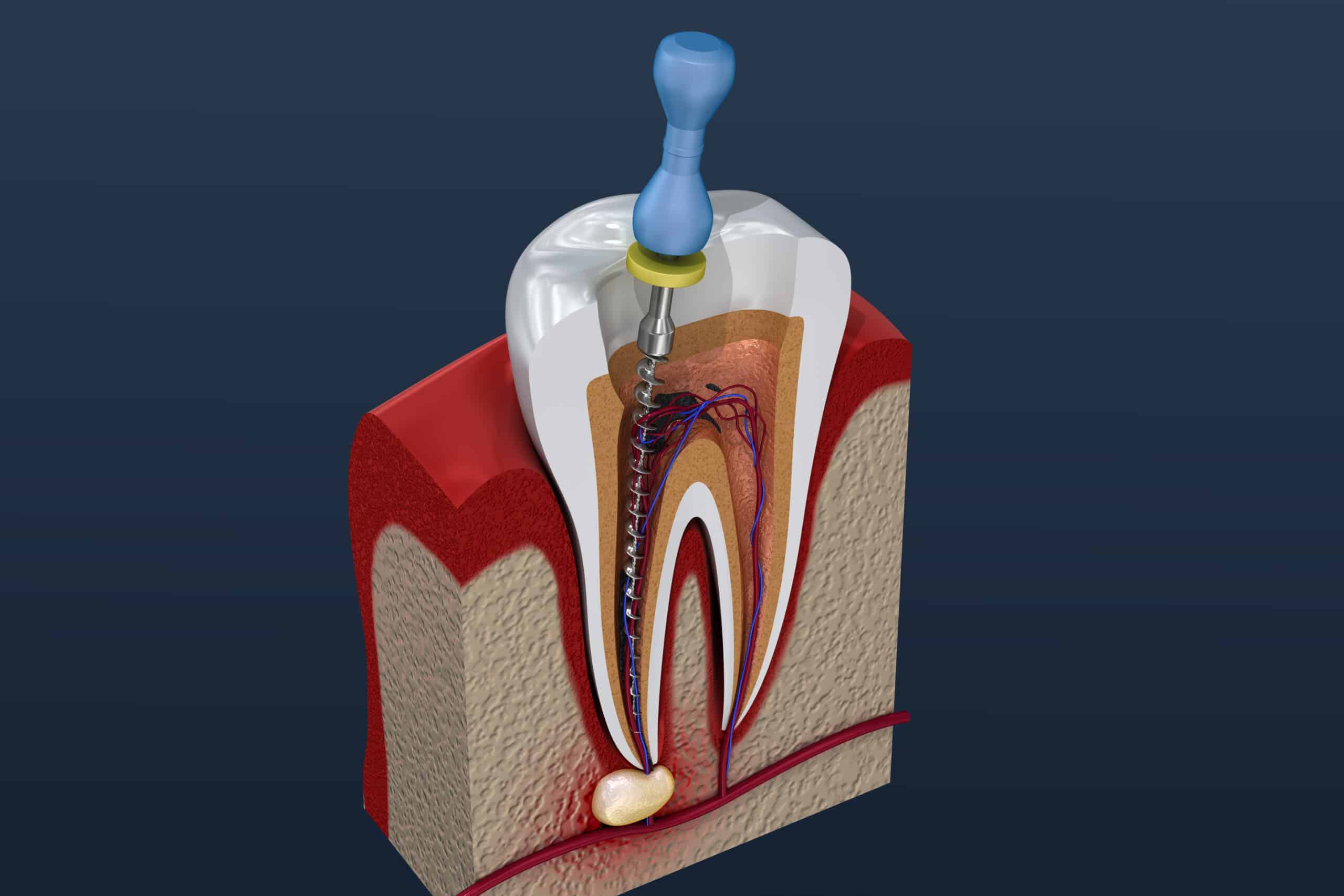 root-canals-what-causes-them-and-how-to-prevent-them-smile-angels